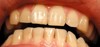 وصفات طبيعية لاصفرار الاسنان P_1589qroq11