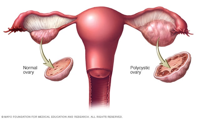 متلازمة المبيض المتعدد الكيسات (PCOS) P_20266pyi21