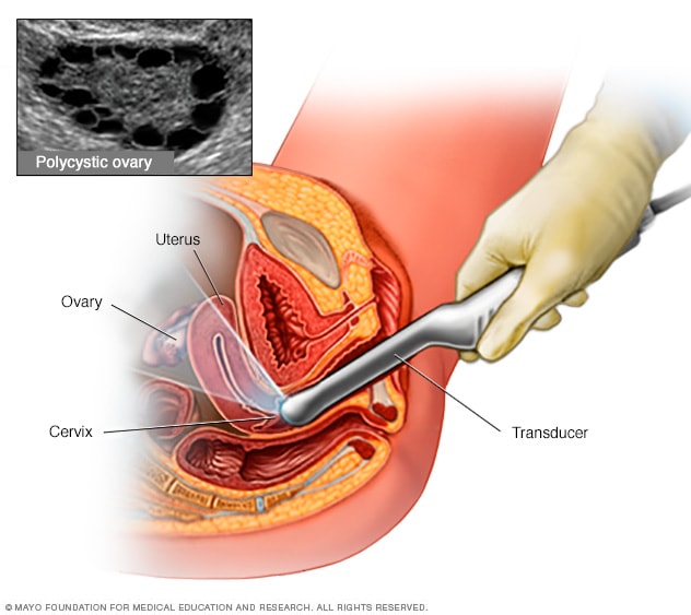 متلازمة المبيض المتعدد الكيسات (PCOS) P_2026taamj1